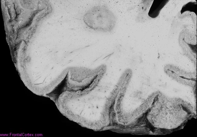 Laminar necrosis of cerebral rib